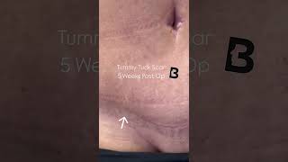 Tummy Tuck Scar 5 Weeks Post Op [upl. by Nwahsan346]