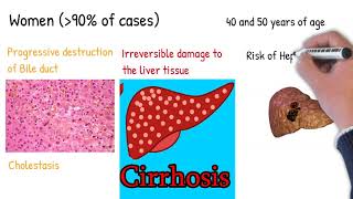 Primary biliary cirrhosis Primary biliary cholangitis Simply Explained [upl. by Nutsud]