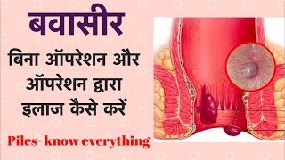 बवासीर  बिना ऑपरेशन और ऑपरेशन द्वारा इलाज कैसे करें  Piles  Hemorrhoids [upl. by Amoreta826]