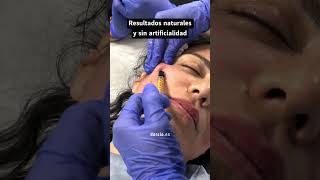 💥 𝗟𝗜𝗣𝗢𝗖𝗨𝗕𝗘 💥rejuvenece y mejora tu piel con ayuda de tu propia grasa ⁣medicinaestetica [upl. by Gnilrad523]