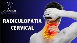 RADICULOPATIA CERVICAL [upl. by Meg]