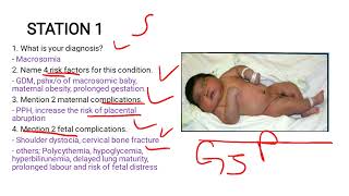 Macrosomia Case Study [upl. by Eblehs]