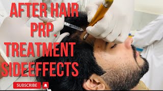 After hair PRP treatment side effects 😰 [upl. by Irisa]