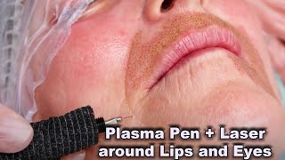 Plasma pen fibroblast treatment before and after  Video tutorial and tips [upl. by Muire588]