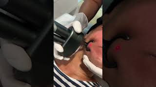 CO2 fractional laser for laser skin resurfacing [upl. by Nydroj436]