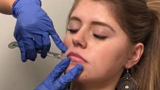 How Does Lip Filler Work with a Naturally Thin Lip Nashville Injector [upl. by Aramen]