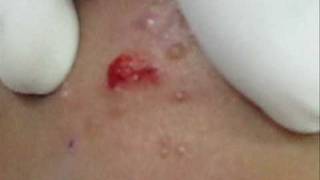 Treatment of Molluscum Contagiosumwmv [upl. by Bixby]