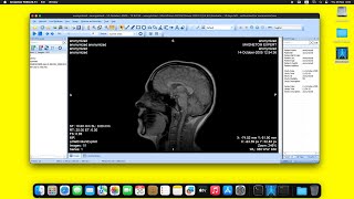 MicroDicom DICOM Viewer on macOS Sequoia using Wine [upl. by Rambow]