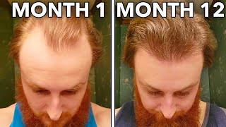 How To Reverse Hair Loss In 12 Months [upl. by Hildie]