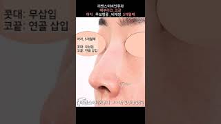 비개방 코성형  여자 매부리코성형 코끝성형 [upl. by Stauder]