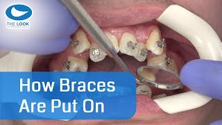 How braces are put on  AMAZING   Now with 12 month  Progress  httpsgoogljXaY15 [upl. by Nirag]