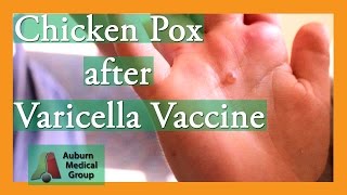 Chicken Pox after Varicella Vaccine  Auburn Medical Group [upl. by Kori58]