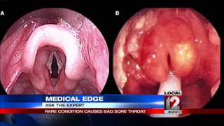 Ask the Expert Rare condition causes bad sore throat [upl. by Addam]