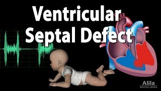 Ventricular Septal Defect Animation [upl. by Ranitta]