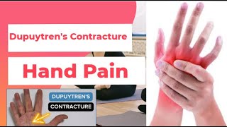 Dupuytrens Contracture  Hand Pain  PhysiotherapyKnowledge [upl. by Augustine755]