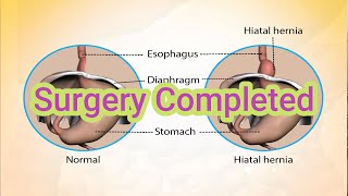 My Experience with Hiatal Hernia Repair and Nissan Fundoplication [upl. by Nneb]