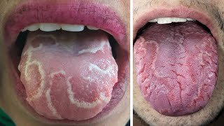 How to Get Rid of Geographic Tongue Fast  8 Best Geographic Tongue Home Remedies [upl. by Manning]