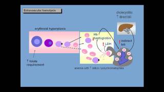 Anemia of increased red cell destruction loss [upl. by Biagi]