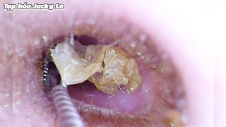 Ear Wax Removal 223 My favorite ear wax removal tool Dry and itchy ear wax  Ear Cleaning ASMR [upl. by Calan]