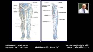 Diagnostica delle varici con eco color doppler [upl. by Petes]