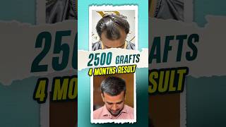 2500 Grafts Hair Transplant  4 Months Result hairtransplant hair shorts ytshorts [upl. by Rrats706]