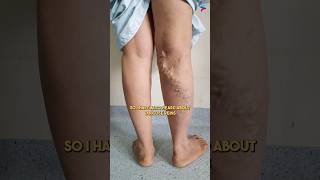 Can You Really Get Rid of Varicose Veins in Just 24 Hours [upl. by Waugh]