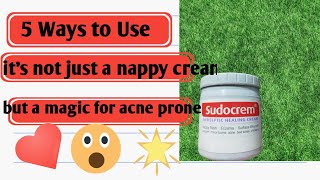 I Tried Sudo Cream For Acne [upl. by Jorgenson]