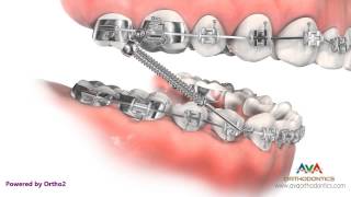 Orthodontic Treatment for Overjet Overbite  Forsus Appliance [upl. by Galligan]