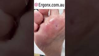 Painful forefoot callus temoval by podiatrist in clinic [upl. by Ttik]