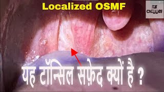 यह टॉन्सिल सफ़ेद क्यों है  क्या मुझे कैन्सर तो नहीं है  Tonsillar Submucous fibrosis I OSMF I [upl. by Prud342]