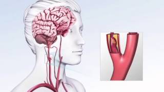 Animation 1 Transient Ischemic Attack [upl. by Dworman621]