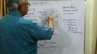 Pathology hydronephrosis part 1 [upl. by Kala897]