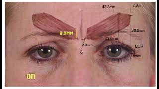 Indepth Guide To Treating The GlabellaForehead With Botox  Dr Chris Hutton [upl. by Griffin]