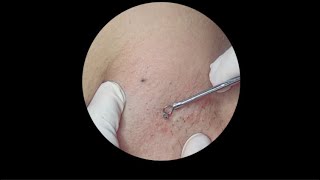 ASMR Remove blackheads and ingrown hair blackhead asmr satisfyingvideo [upl. by Enalb]