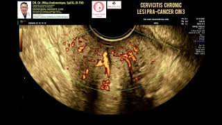 Cervicitis chronic  Lesi Pracancer  CIN 3 [upl. by Sulecram]