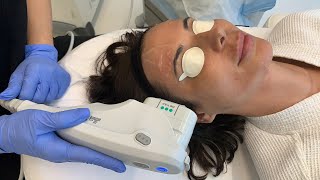 ULTHERAPY SKIN TIGHTENING AND EYEBROW LIFTING WITHOUT SURGERY West Hollywood CA  Dr Jason Emer [upl. by Ursola]