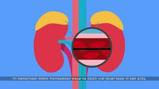 Primary Aldosteronism identifying the abnormal adrenal gland Malay [upl. by Neeloj983]