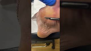 Taking steps to foot comfort Watch how an Aussie podiatrist takes down a stubborn callus [upl. by Enneite]