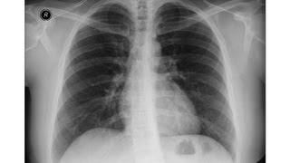 Chest xray  Asbestosis  Pleural calcifications  Round atelectasis [upl. by Weisman]