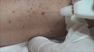 Angioma Removal with Plexr [upl. by Cesar460]