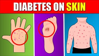 11 Symptoms of Diabetes by Looking at Your Skin [upl. by Haimrej]