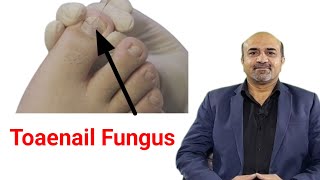 What Is Toenail Fungus  How To Prevent amp Manage Toaenail Fungus  dr afzal [upl. by Camille442]