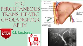 PTCPTHC PERCUTANEOUS TRANSHEPATIC CHOLANGIOGRAPHY Procedure HindiEnglish for BRT amp DRT students🥰 [upl. by Aitnis]