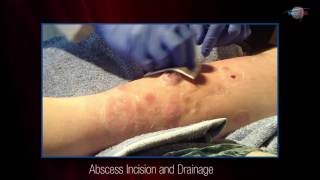 WCW Abscess Incision and Drainage [upl. by Endres461]