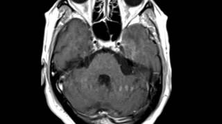 HSV Encephalitis [upl. by Ossie414]