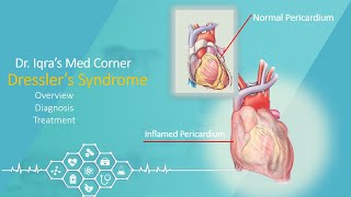 Dresslers Syndrome  Post Myocardial Infarction  Posttraumatic pericarditis Dr Iqras Med Corner [upl. by Nolitta]