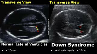 Fetal Ultrasound Normal Vs Down Syndrome  Soft Markers In Fetus For Trisomy 21  Aneuploidies USG [upl. by Aiem676]