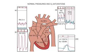 Right Heart Catheterization  an introduction [upl. by Drandell]