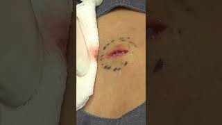 Watch Js story then click over to watch the full procedure Click below to watch drpimplepopper [upl. by Maureene]