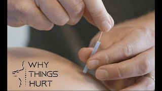 IMS Dry Needling Quadriceps [upl. by Gipson]